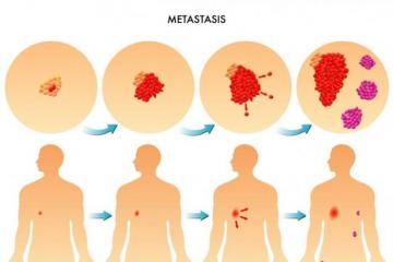 How do bone metastases manifest?