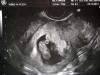 Чорна кров на 7 тижні вагітності